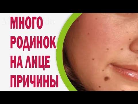 Отбеливающий крем или маски Пигментация на лице с мальчиками