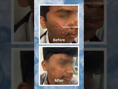 Why dark spots and uneven skin tone happen