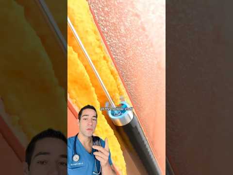 Doctor Explains: inside a leg artery