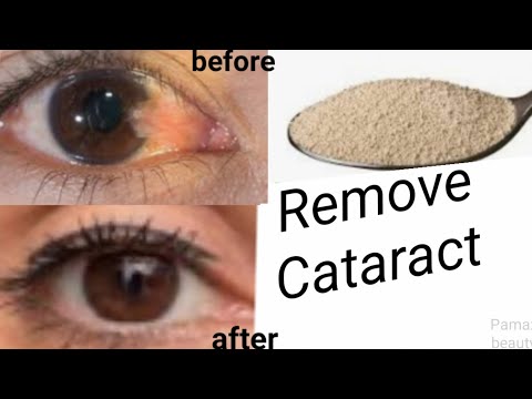 REMOVE CATARACTS WITHOUT SURGERY NO MORE EYE GLASSES USE THIS REMEDY INSTEAD