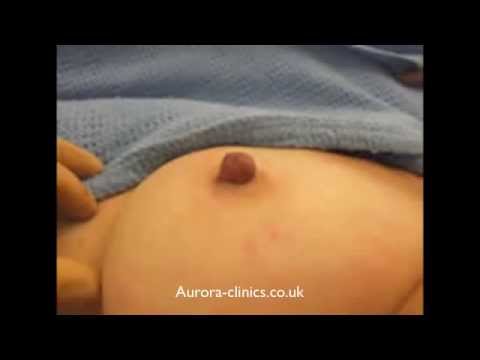 Inverted Nipple patient testimonial | Aurora Clinics UK