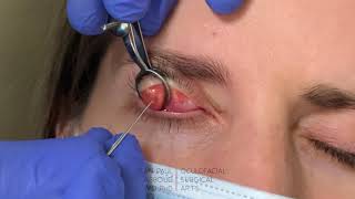 Incision and Drainage of a Chalazion/Stye