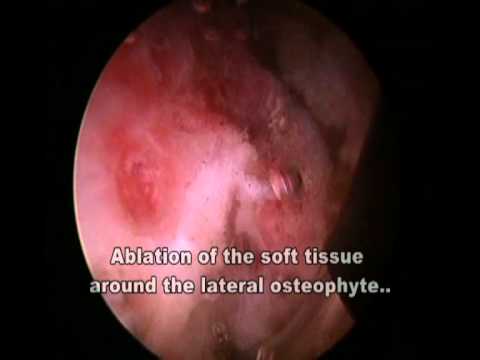 Hip Arthroscopy Prep and Keyhole