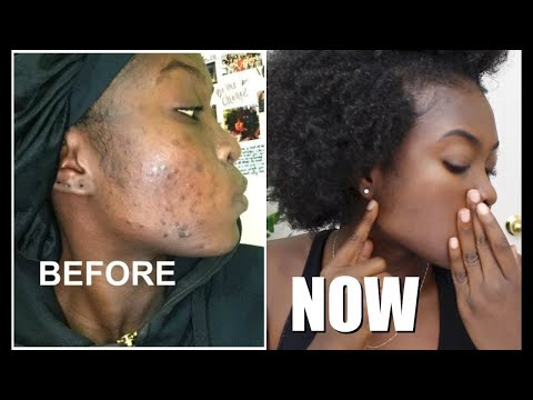 Amabara yo mu maso Uburyo 5 bworoshye wayarwanya