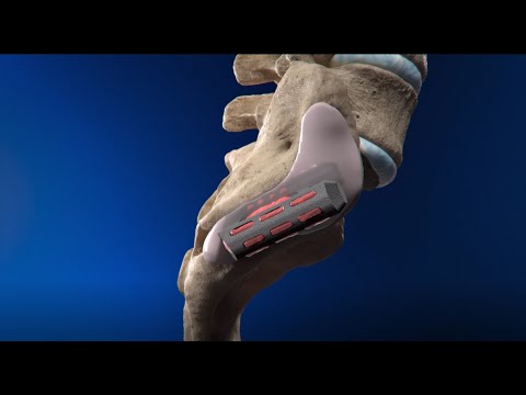 Catamaran™ SI Joint Fusion System