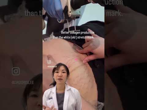 When is the best time to treat stretch marks?