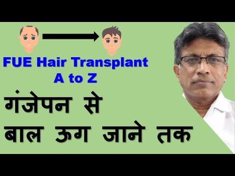 FEU Transplant: Hair Loss to 9 months' result (2011)