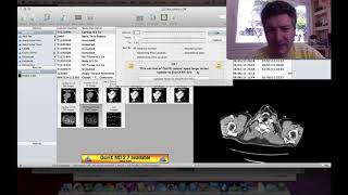 OsiriX Gratuito vs Pago
