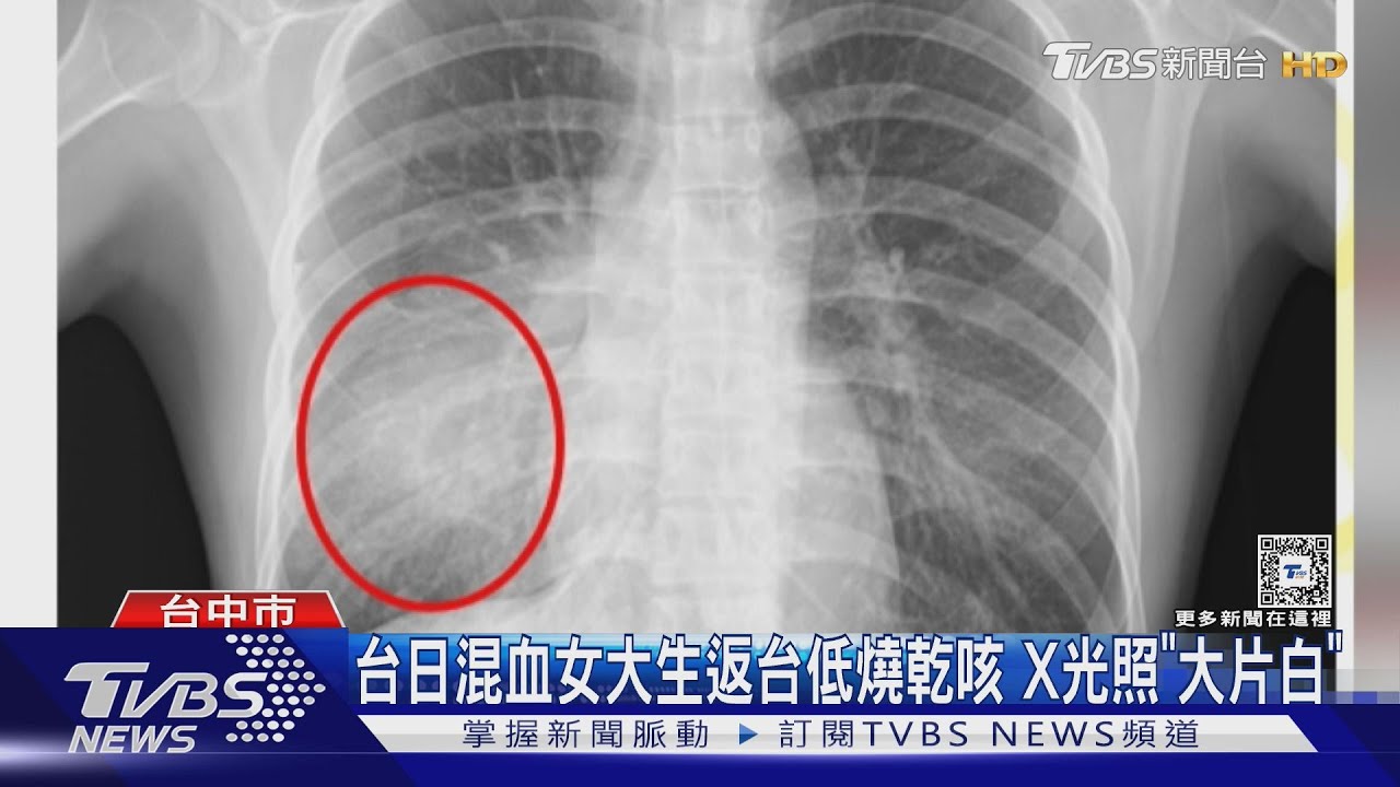 台日混血女大生返台低燒乾咳 X光照「大片白」確診黴漿菌肺炎