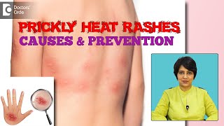 Prickly Heat Summer Rash- Know the Causes & Tips to prevent it? - Dr. Rasya Dixit | Doctors