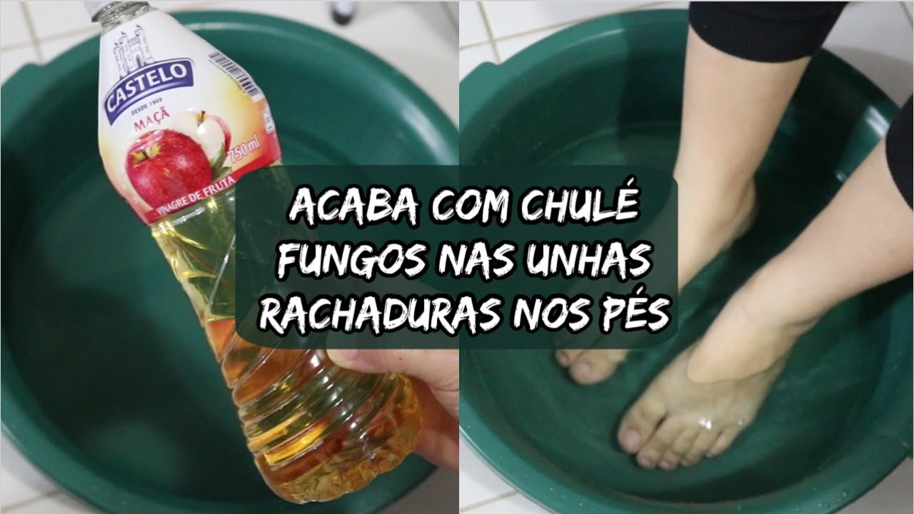 Esse Escalda Pés ACABA COM AS RACHADURAS CHULÉ E FUNGOS NAS UNHAS