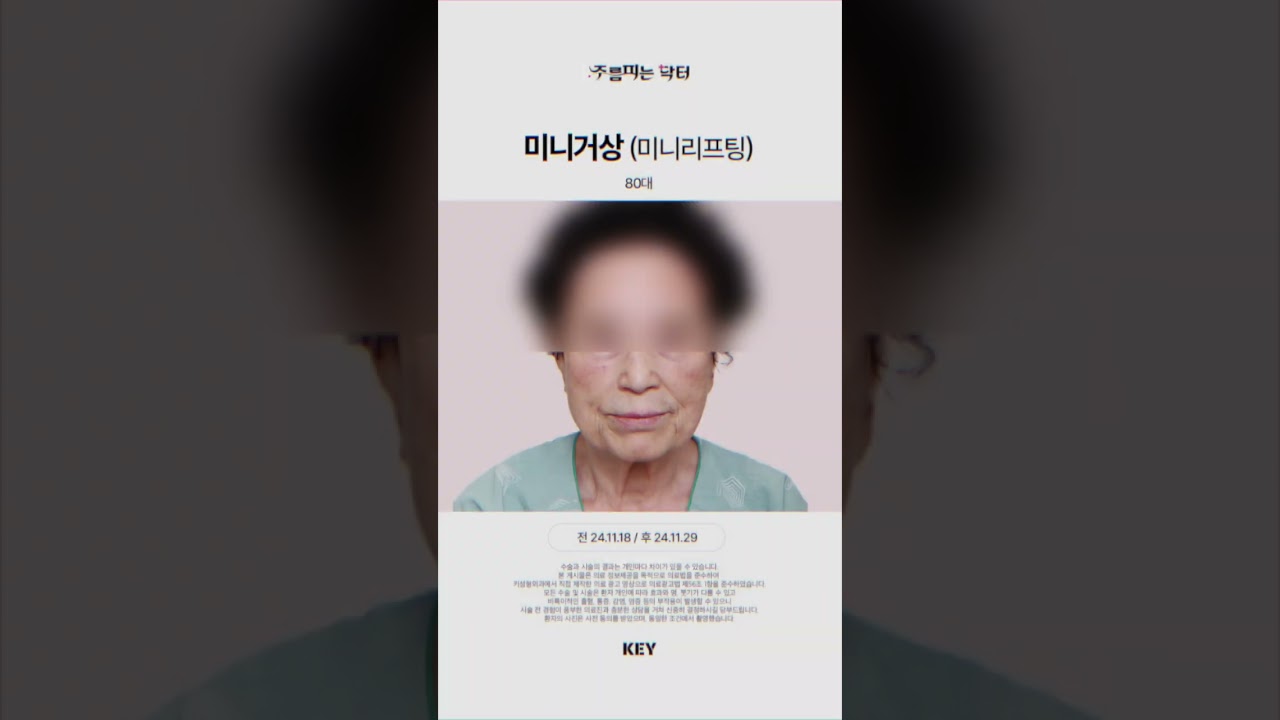 80대의 미니거상 미니리프팅 대구키성형외과