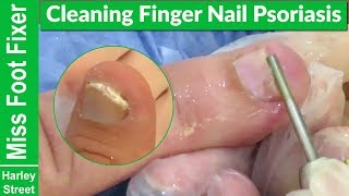 What does Psoriasis nails looks like? How to clean nail Psoriasis |  Psoriasis Treatment