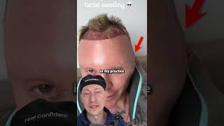 INSANE Facial Swelling! | Plastic Surgeon Reacts