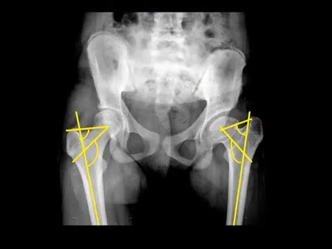 Coxa Vara in Children