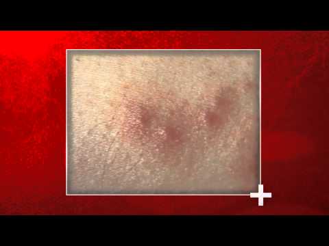 Signs of Bed Bug Bites - Health Checks