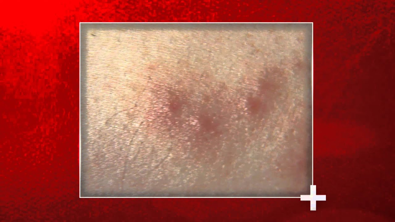 Beware of Bed Bugs: 10 Telltale Signs of a Bite, Beauty Vigour