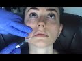 Lip Injections- Restylane Silk with Dr. Tehrani