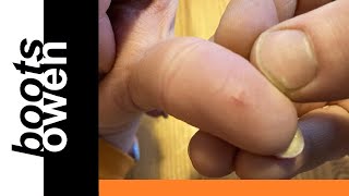 Try this one simple trick to remove a splinter or thorn stuck in your finger