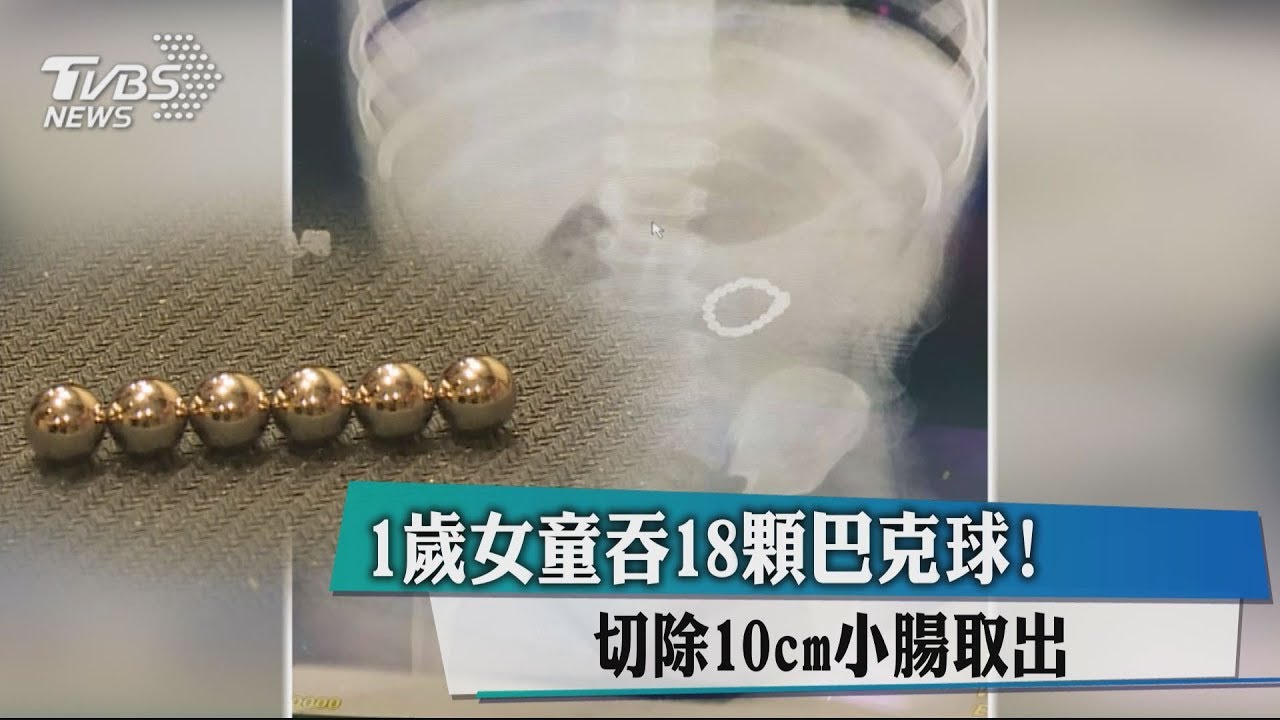 1歲女童吞18顆巴克球! 切除10cm小腸取出