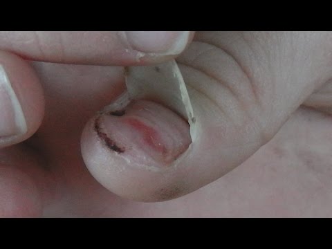 Gribki auf den Nägeln der Beine welche Salben Die Behandlung des weggehenden Nagels auf der Hand