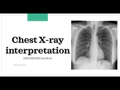 Chest X-ray interpretation (ABCDEFGHI method)