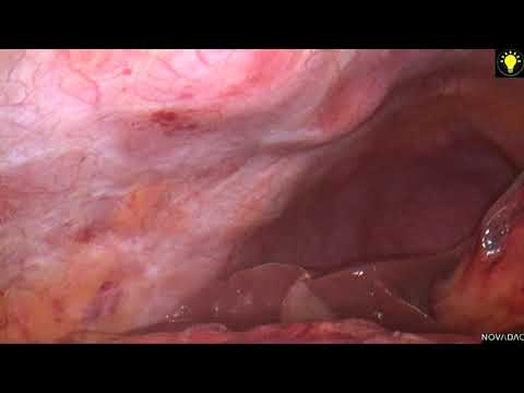 Laparoscopic-guided Transversus Abdominis Plane (TAP) block for abdominal surgery