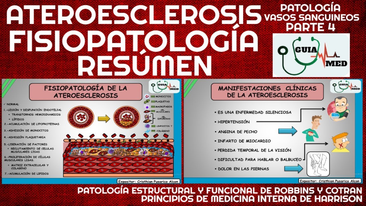 ATEROESCLEROSIS FISIOPATOLOGÍA RESÚMEN | GuiaMed