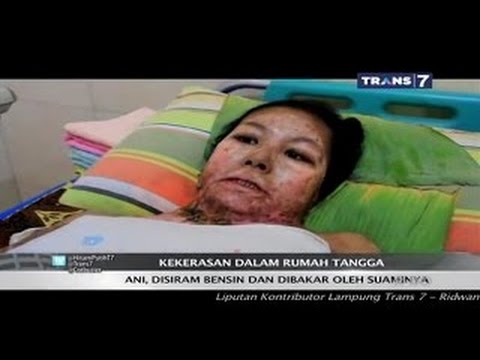 Hitam Putih 16 April 2015 Full - Kasus Istri Disiram Bensin Dan Dibakar Oleh Suaminya.