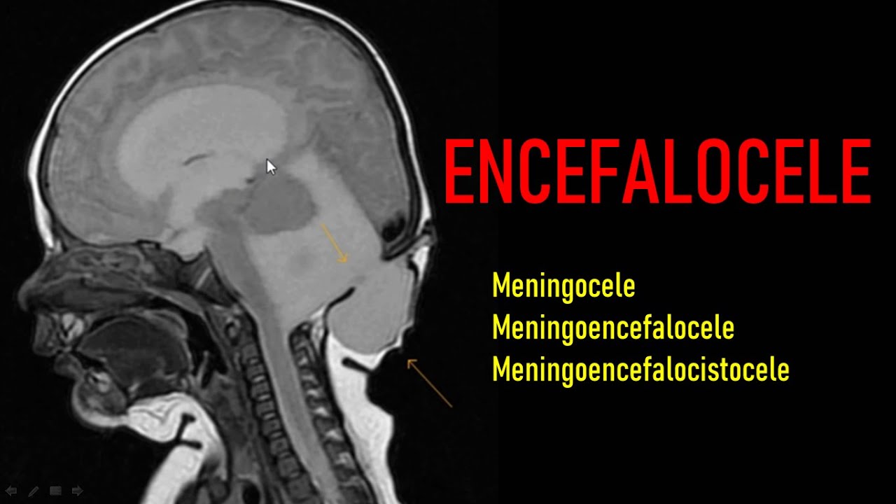 Encefalocele - Malformações Congênitas (Neuroradiologia)
