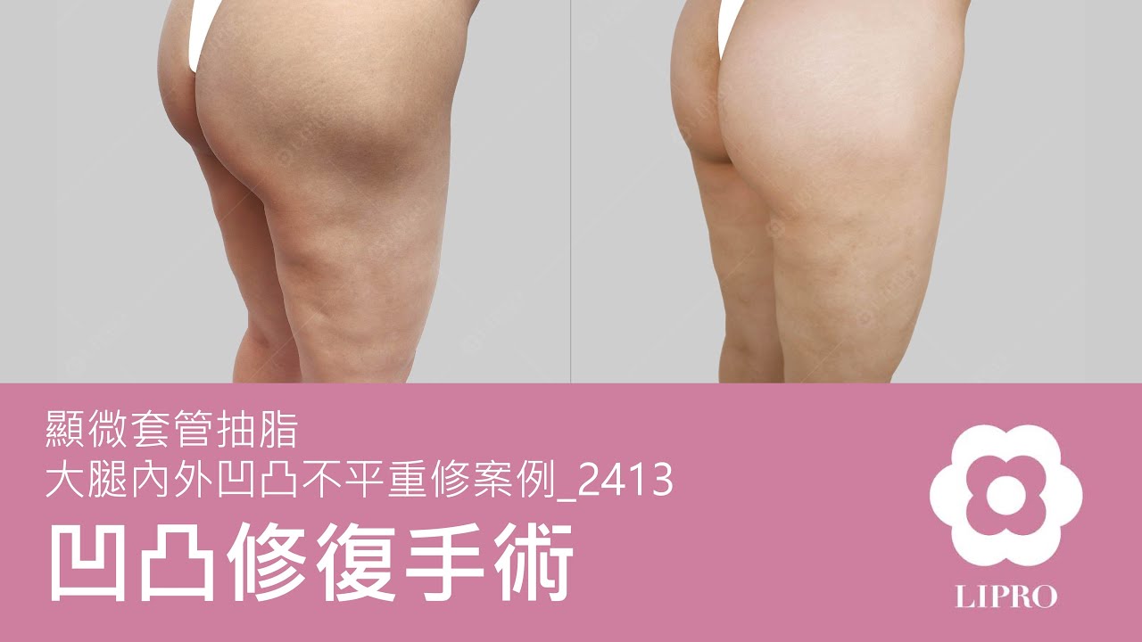 凹凸修復手術｜顯微套管抽脂｜大腿內外凹凸不平重修案例_2413