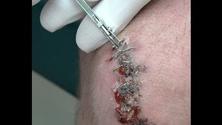 Staple Removal Sharpie Knee, Jenny Gore Warning!