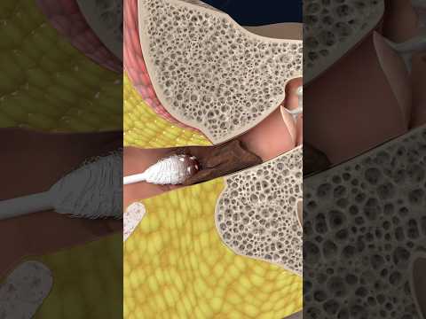 Earwax buildup explained in 3D: how cerumen impaction forms 🦻 #3danatomy #humanbody