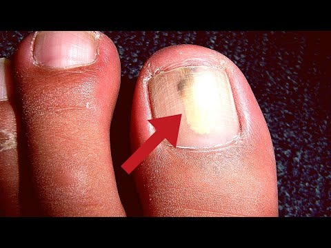 Gribok die Salbe eksoderil in Wie es schnell ist, gribok des Nagels herauszuführen