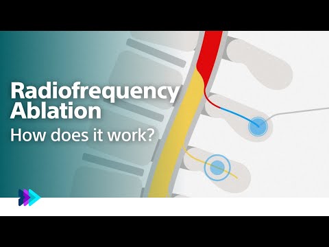 How Radiofrequency Ablation (RFA) procedure works