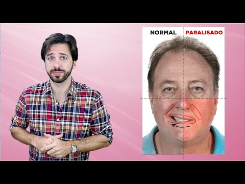 Stroke Symptoms - Cerebrovascular Accident