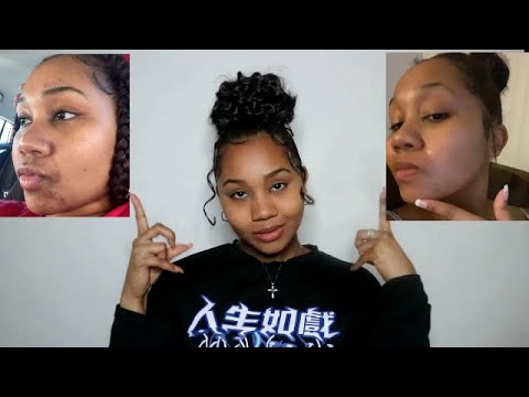 How I Got Rid of My Severe Tinea Versicolor! | Home Remedies!