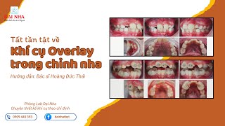 Tất tần tật về khí cụ Overlay trong chỉnh nha điều trị khớp cắn