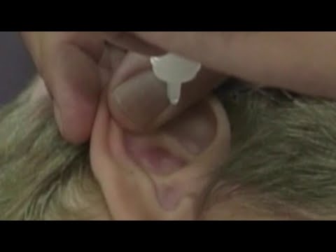 At-home remedy to swimmer's ear