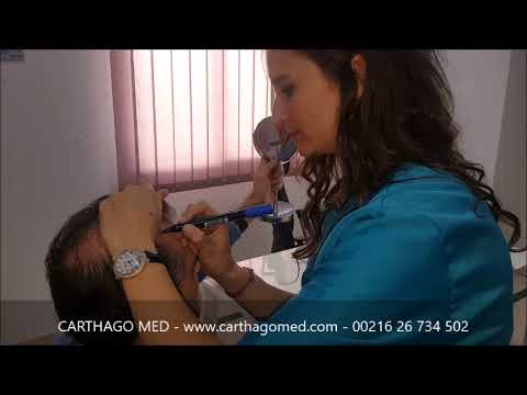 Greffe de Cheveux Tunisie : Implant Capillaire FUE - Carthagomed