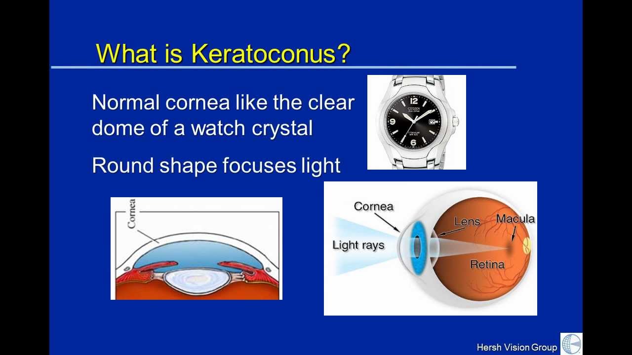 Introduction to Keratoconus by Dr. Peter Hersh