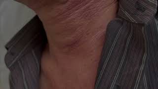 Asvide: Demonstrates the clinical evaluation (via inspection and palpation) of an elderly female...