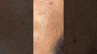 Relaxing acne treatment Linhmydang #acne #acnetreatment #shortvideo #skincare #pimplepopping