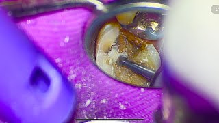 "90° Curve Challenge: Conquering the Impossible Calcified Molar Endodontic Pulpectomy!"