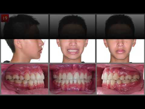 CC442. Bimaxillary Protrusion Treated with Insignia® System Customized Brackets and Archwires