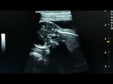 normal fetal brain at 16 weeks