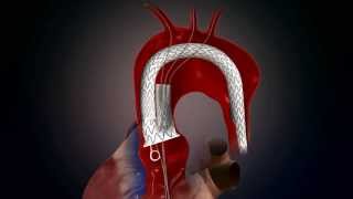 Thoracic Stent Animation