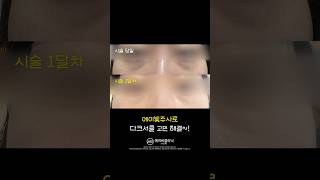 컨실러 없이 다크써클 지우는 법