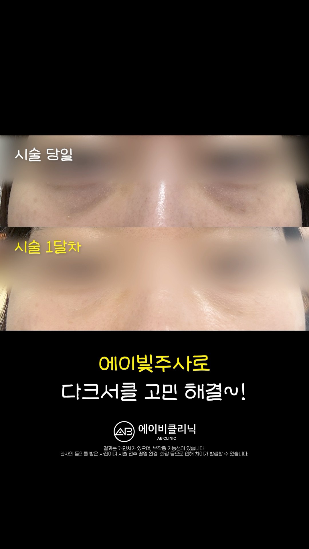 컨실러 없이 다크써클 지우는 법