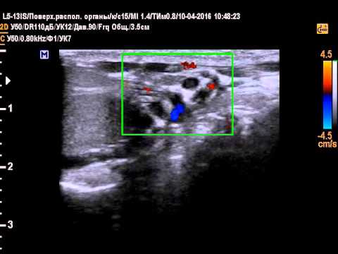 Варикоцеле ЦДК проба Вальсальвы